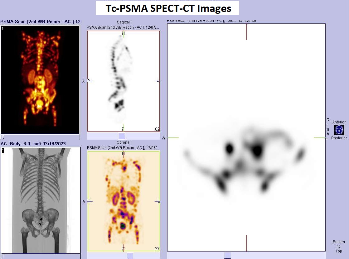 PSMA SPECT-CT